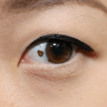 Medical Blogs - Eye melanoma feat image