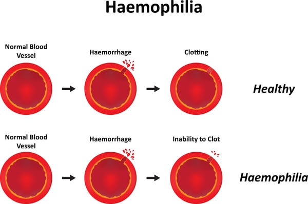 Medical Blogs - Hemophilia image
