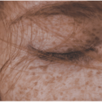 blog-hyperpigmentation