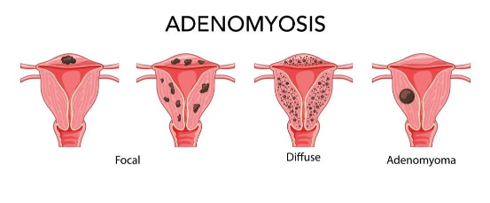 Medical Blogs - Adenomyosis stages