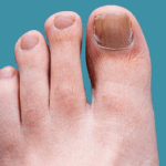 Fungal Nail Infection