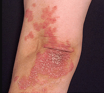 blog-psoriasis