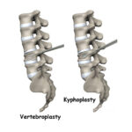 Business Opportunities Offered - kyphoplasty-and-vertebroplasty