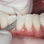 blog-tooth stripping