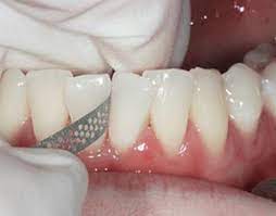 blog-tooth stripping