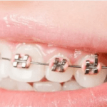 Online Medical Product - Dental Metal Brackets Diamond Series